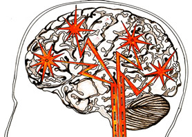 Brain Plasticity - Chronic Pain Visualisation Picture Drawing