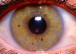 Iris photo - right eye