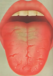 Tongue Diagnosis 
